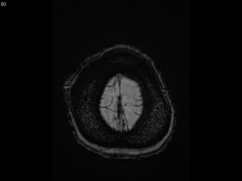 Atypical meningioma - intraosseous (Radiopaedia 64915-74572 Axial SWI 80).jpg