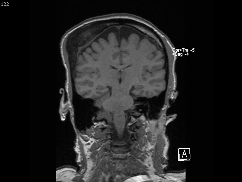 File:Atypical meningioma - intraosseous (Radiopaedia 64915-74572 Coronal T1 122).jpg