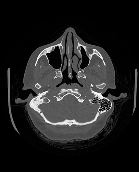 File:Automastoidectomy with labyrinthine fistula (Radiopaedia 84143-99411 Axial non-contrast 67).jpg