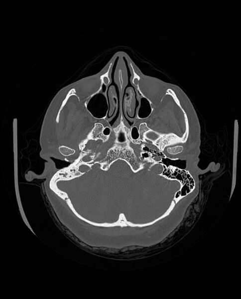 File:Automastoidectomy with labyrinthine fistula (Radiopaedia 84143-99411 Axial non-contrast 75).jpg