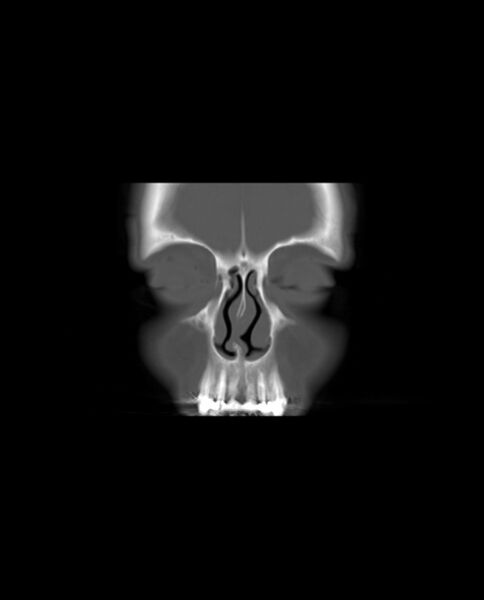 File:Automastoidectomy with labyrinthine fistula (Radiopaedia 84143-99411 Coronal non-contrast 8).jpg