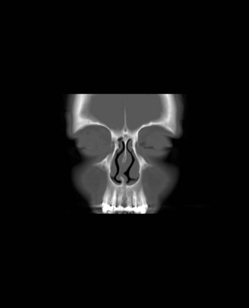 Automastoidectomy with labyrinthine fistula (Radiopaedia 84143-99411 Coronal non-contrast 8).jpg