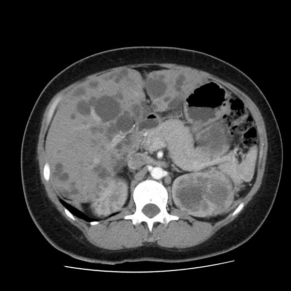 File:Autosomal dominant polycystic kidney disease (Radiopaedia 23061-23093 B 22).jpg
