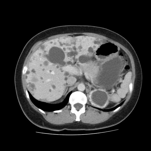 File:Autosomal dominant polycystic kidney disease (Radiopaedia 23061-23093 C 18).jpg