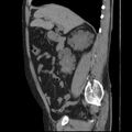Autosomal dominant polycystic kidney disease (Radiopaedia 36539-38101 D 33).jpg