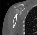 Avulsion fracture - greater tuberosity of humerus (Radiopaedia 71216-81514 Coronal bone window 31).jpg