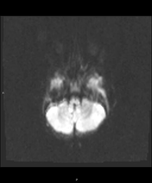 File:Basal ganglia and parenchymal ischemia (Radiopaedia 45818-50084 Axial DWI 7).jpg