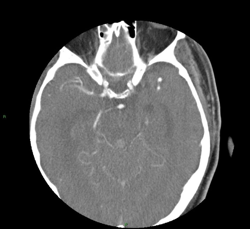 Basal ganglia hemorrhage (Radiopaedia 58763-65985 D 74).jpg