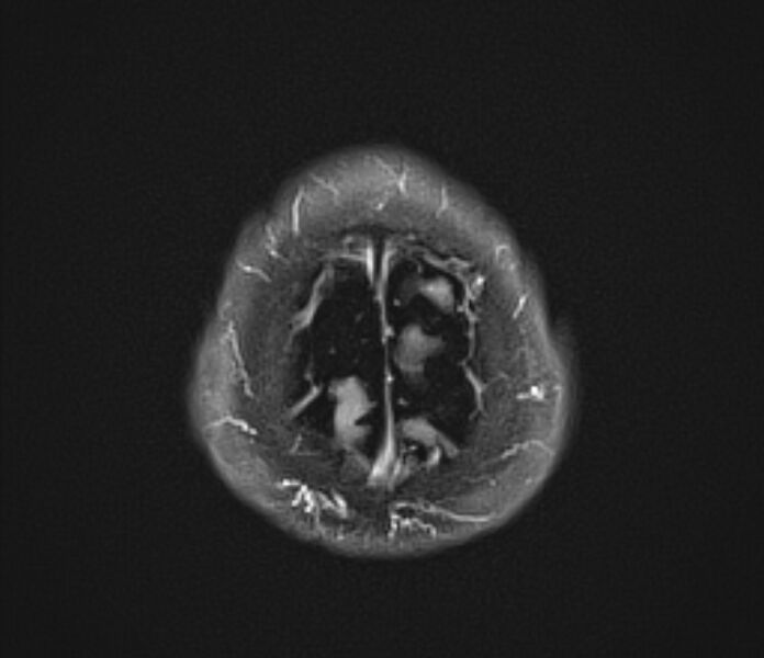 File:Basilar artery dissection (Radiopaedia 77032-88976 Axial FLAIR 23).jpg