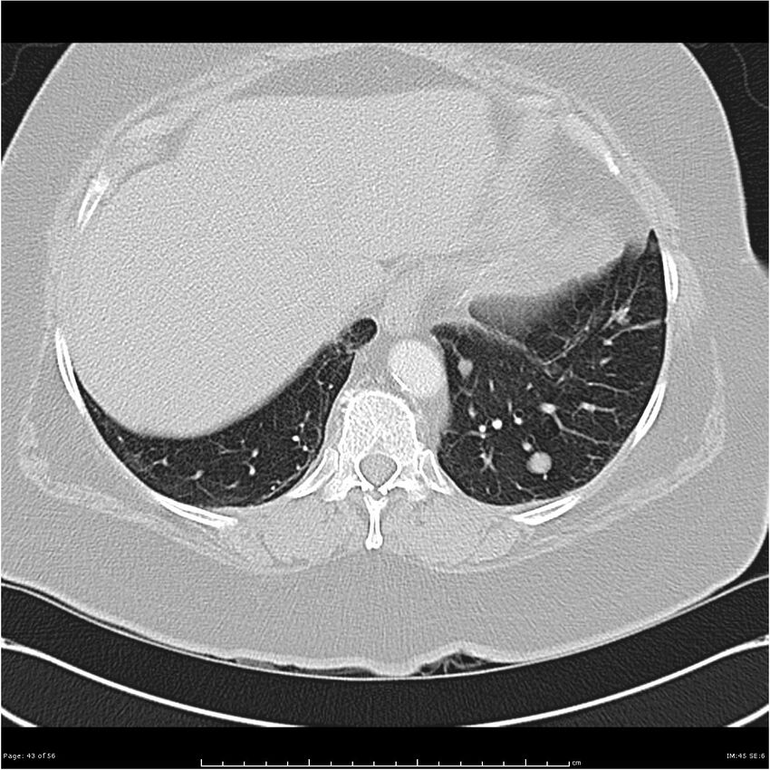Benign metastasizing leiomyoma (Radiopaedia 26803-26962 Axial lung window 43).jpg