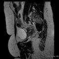 Bicornuate uterus- on MRI (Radiopaedia 49206-54297 Sagittal T2 21).jpg