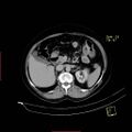 Bifid ureter (Radiopaedia 47604-52253 Axial C+ delayed 6).jpg