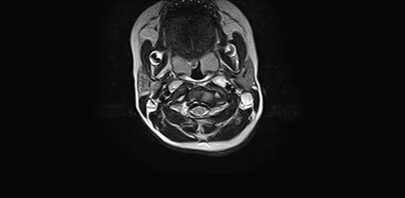 File:Bilateral Sprengel deformity with Klippel-Feil syndrome (Radiopaedia 66395-75650 Axial T2 7).jpg