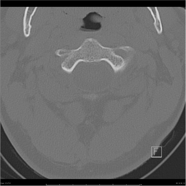 File:Bilateral cervical ribs (Radiopaedia 25868-26017 Axial bone window 13).jpg