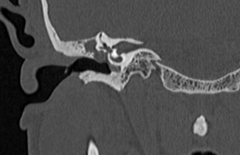 File:Bilateral cholesteatoma (Radiopaedia 54898-61172 Coronal bone window 34).jpg