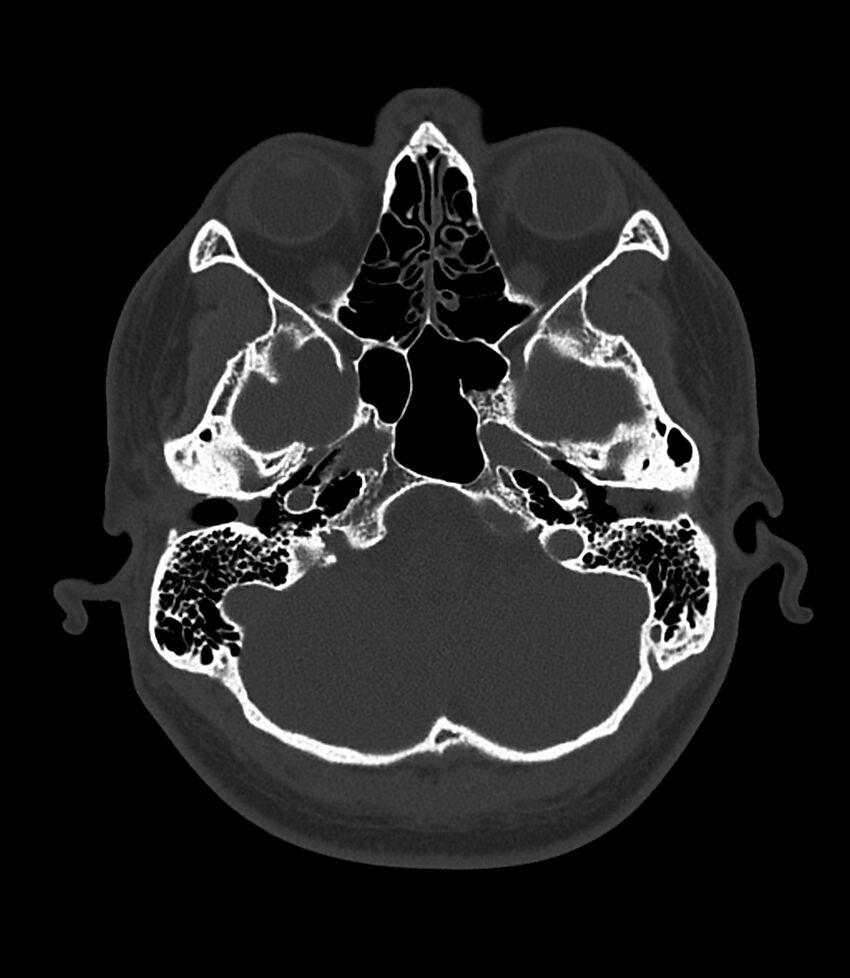 Bilateral medial canal fibrosis (Radiopaedia 85598-101344 Axial bone window 24).jpg