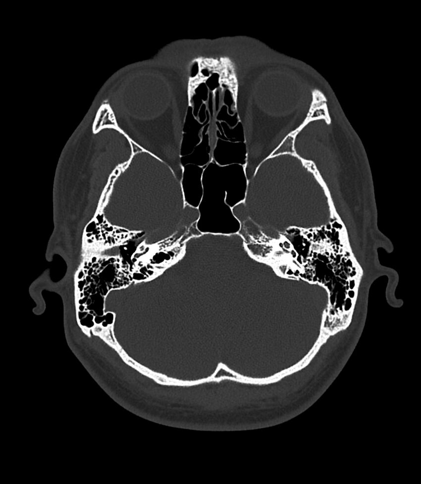 Bilateral medial canal fibrosis (Radiopaedia 85598-101344 Axial bone window 39).jpg