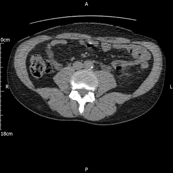 File:Bilateral medullary nephrocalcinosis with ureteric calculi (Radiopaedia 71269-81569 Axial non-contrast 71).jpg