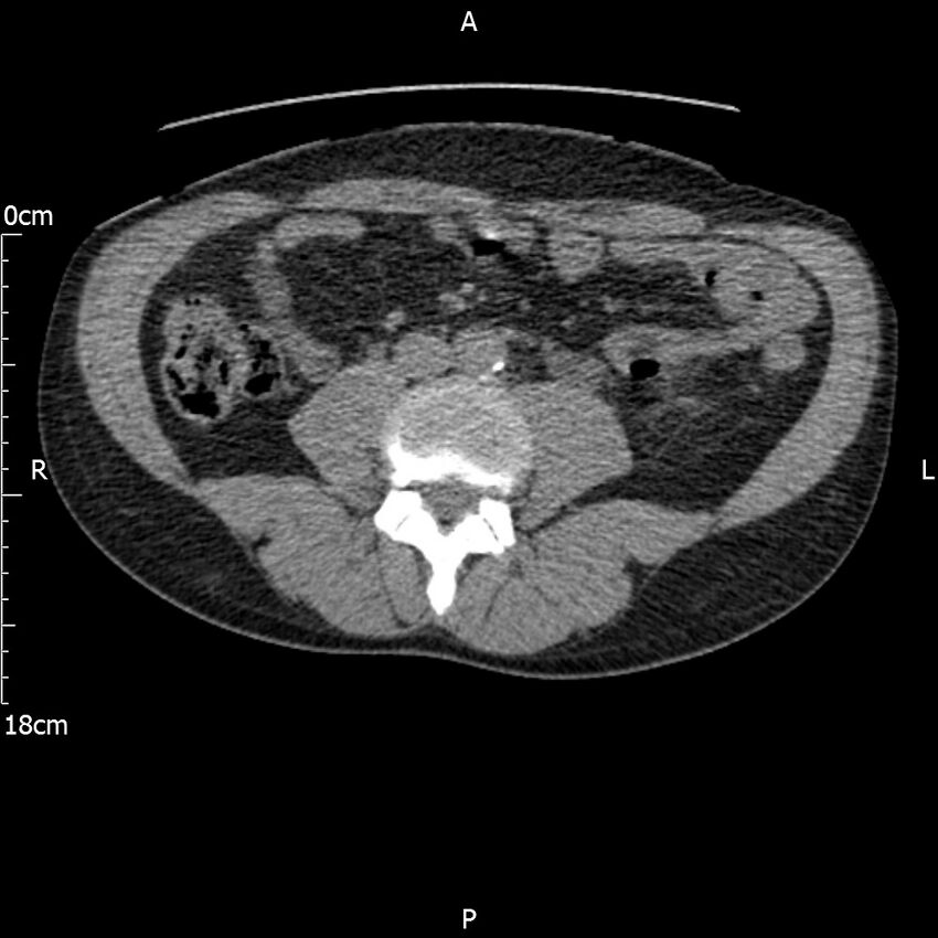 Bilateral medullary nephrocalcinosis with ureteric calculi (Radiopaedia 71269-81569 Axial non-contrast 71).jpg