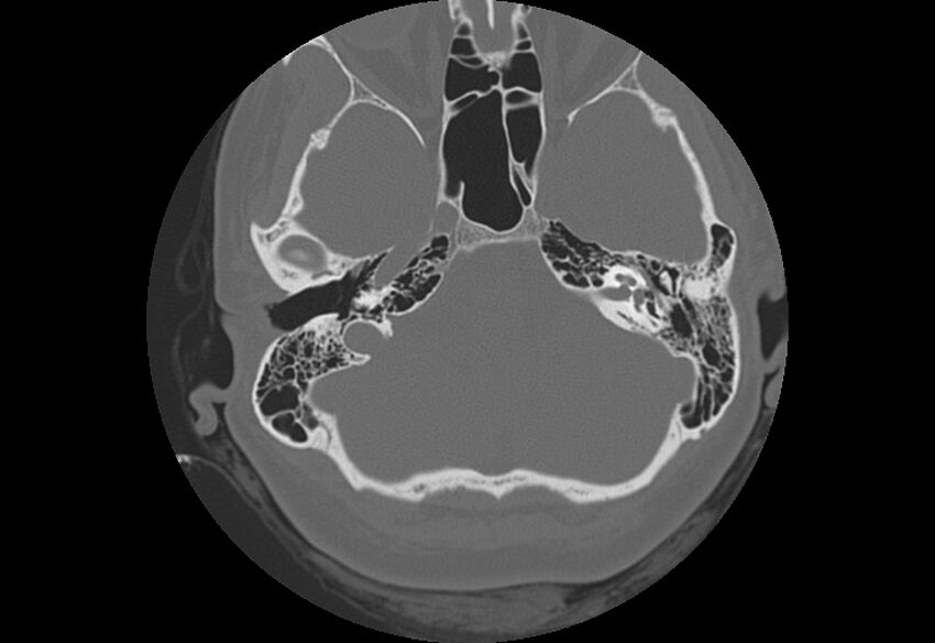 Bilateral otospongiosis (Radiopaedia 35447-36940 B 25).jpg