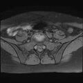Bilateral ovarian endometriomas (Radiopaedia 87085-103347 Axial T1 fat sat 1).jpg