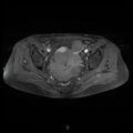Bilateral ovarian fibroma (Radiopaedia 44568-48293 Axial T1 C+ fat sat 16).jpg