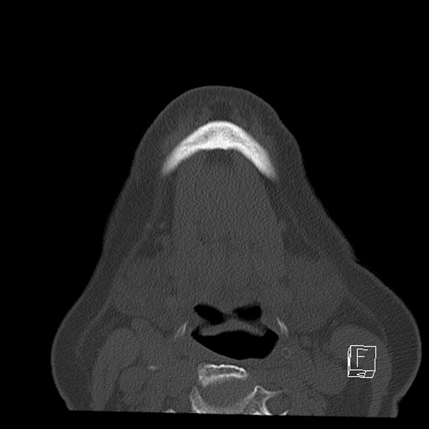Bilateral palatine tonsilloliths on OPG and CT (Radiopaedia 75167-86247 Axial bone window 58).jpg