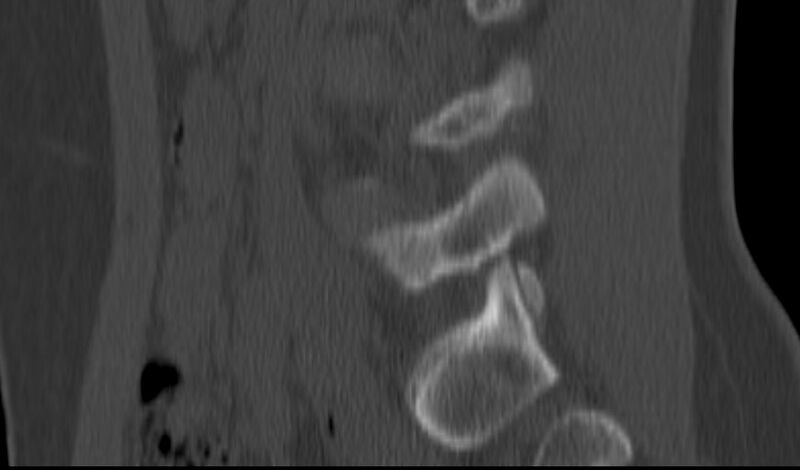 File:Bilateral pars defect (Radiopaedia 26691-26846 Sagittal bone window 20).jpg