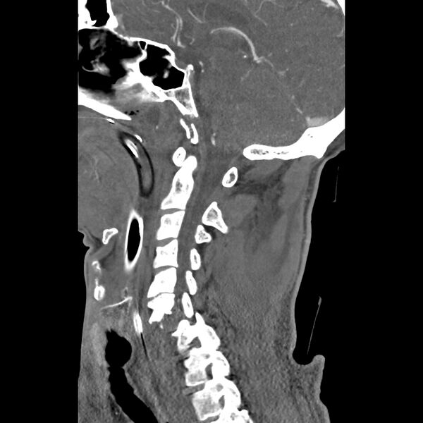 File:Bilateral perched facets with cord injury (Radiopaedia 45587-49713 B 21).jpg