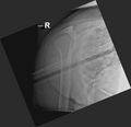 Bilateral posterior shoulder dislocation (Radiopaedia 54102-60520 Lateral 1).jpg