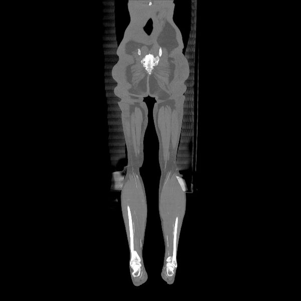 File:Bilateral superficial femoral arterial occlusion (Radiopaedia 25682-25857 Coronal MIP 24).jpg
