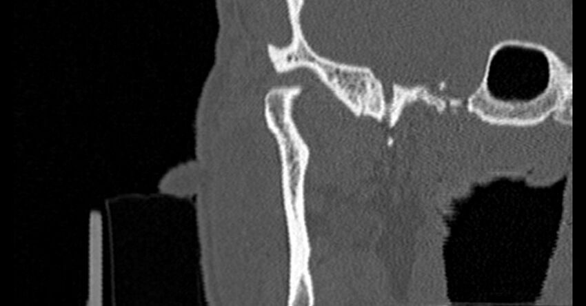 Bilateral temporal bone fractures (Radiopaedia 29482-29970 Coronal non-contrast 33).jpg