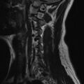 Bilateral tortuous vertebral arteries (Radiopaedia 19070-19039 Sagittal T2 2).jpg