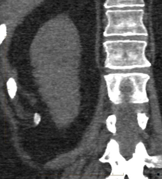 File:Bile leak from accessory duct(s) of Luschka post cholecystectomy (Radiopaedia 40736-43389 B 61).jpg