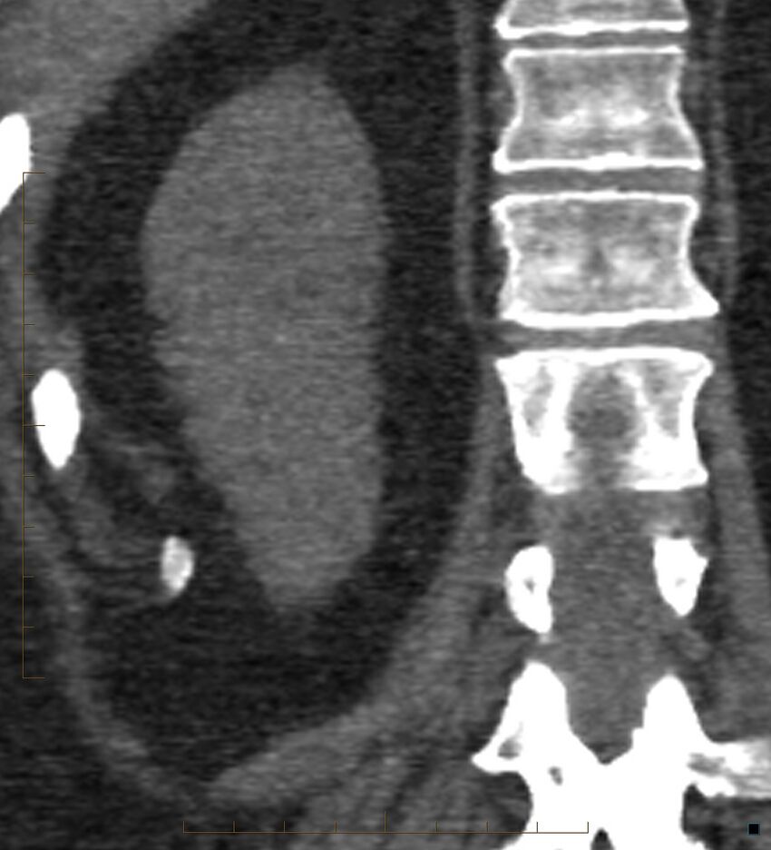 Bile leak from accessory duct(s) of Luschka post cholecystectomy (Radiopaedia 40736-43389 B 61).jpg