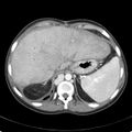 Biliary necrosis - liver transplant (Radiopaedia 21876-21846 B 13).jpg
