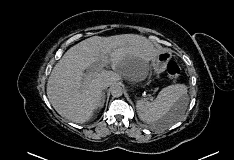 File:Biliary pancreatitis (Radiopaedia 72289-82823 Axial non-contrast 73).jpg