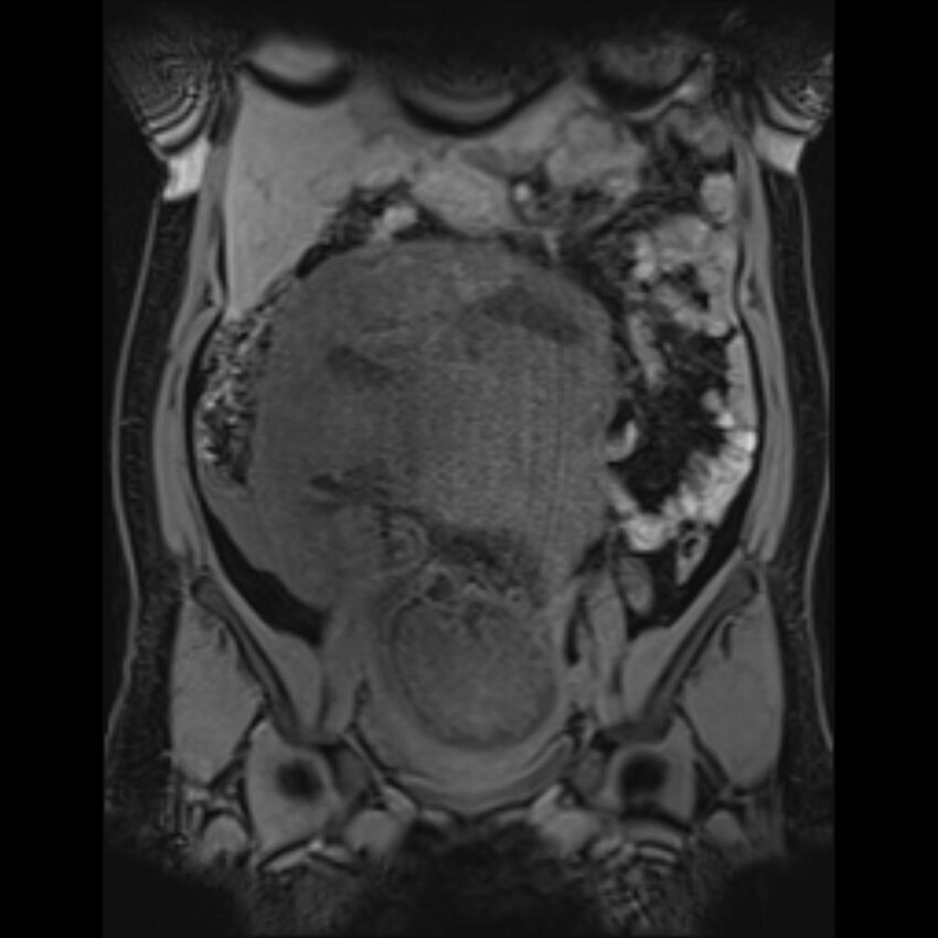 Bilobed placenta accreta (Radiopaedia 69648-79591 Coronal T1 vibe 85).jpg