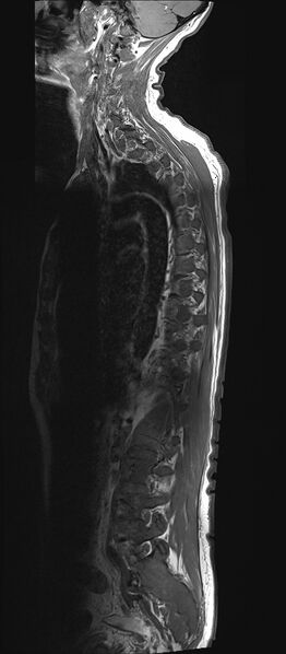 File:Bing-Neel syndrome (Radiopaedia 71453-81799 Sagittal T1 14).jpg