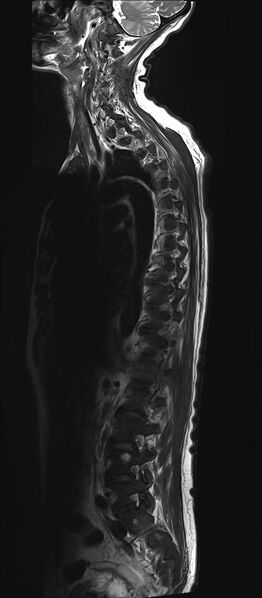 File:Bing-Neel syndrome (Radiopaedia 71453-81799 Sagittal T2 13).jpg