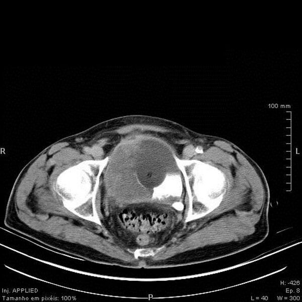 File:Bladder squamous cell carcinoma (Radiopaedia 14130-13984 C 10).jpg