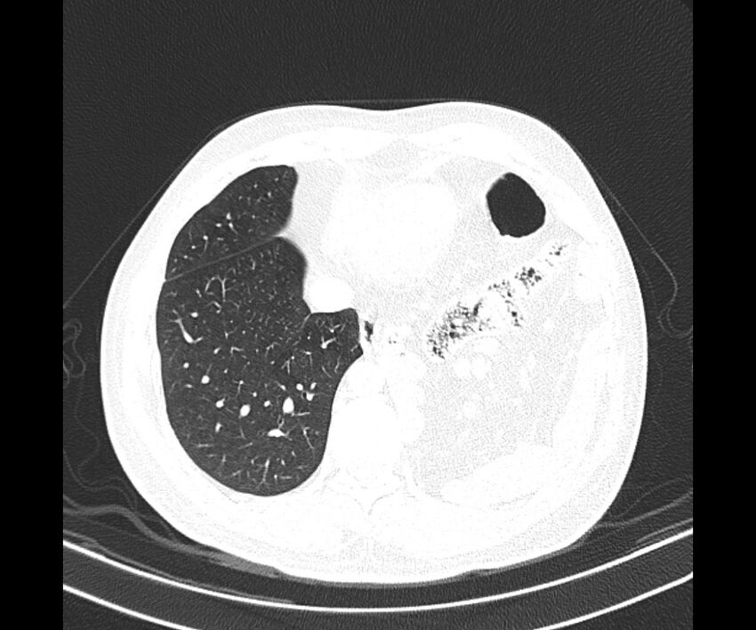 Bochdalek hernia - adult presentation (Radiopaedia 74897-85925 Axial lung window 35).jpg