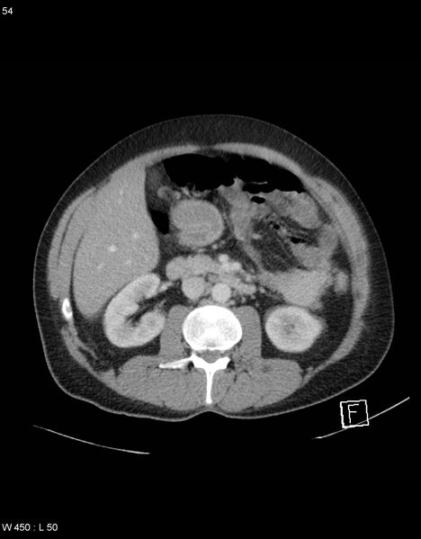 File:Boerhaave syndrome with tension pneumothorax (Radiopaedia 56794-63603 A 27).jpg