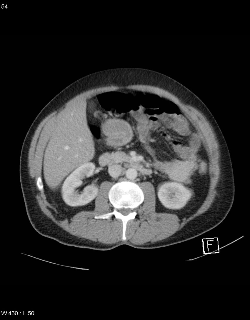Boerhaave syndrome with tension pneumothorax (Radiopaedia 56794-63603 A 27).jpg