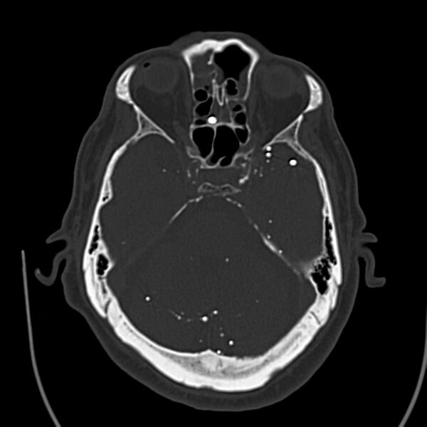 File:Brain Pantopaque remnants (Radiopaedia 78403-91048 Axial bone window 27).jpg