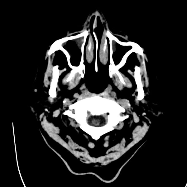 File:Brain Pantopaque remnants (Radiopaedia 78403-91048 Axial non-contrast 10).jpg