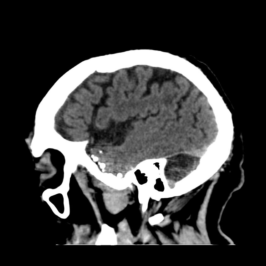 Brain Pantopaque remnants (Radiopaedia 78403-91048 C 44).jpg