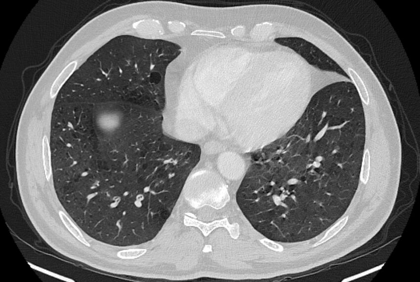Brain metastases - lung cancer primary (Radiopaedia 75060-86116 Axial lung window 44).jpg