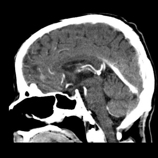 File:Brain metastases from lung cancer (Radiopaedia 24480-24781 C+ delayed 30).jpg