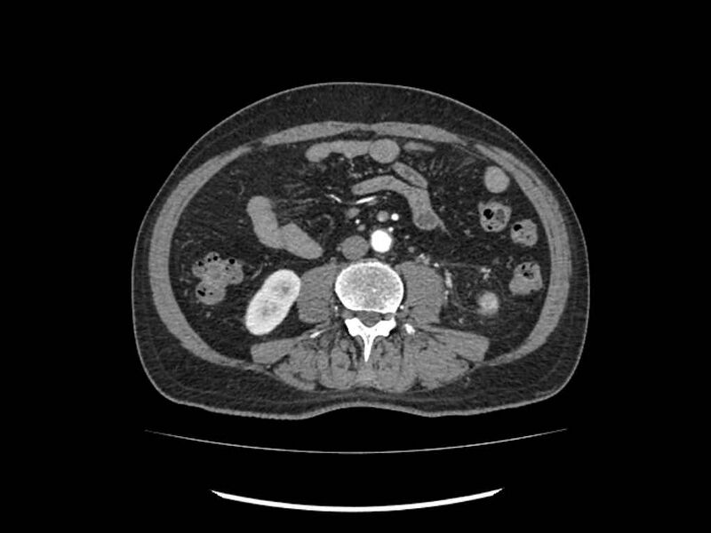 File:Brain metastases from renal cell carcinoma (Radiopaedia 42222-45328 A 154).jpg